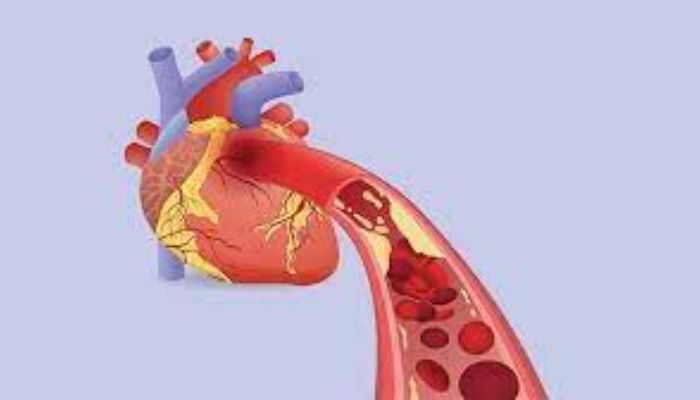 Bệnh thiếu máu cơ tim là gì?